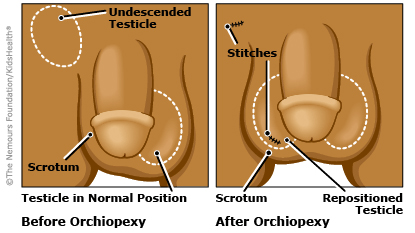 Undescended testicle